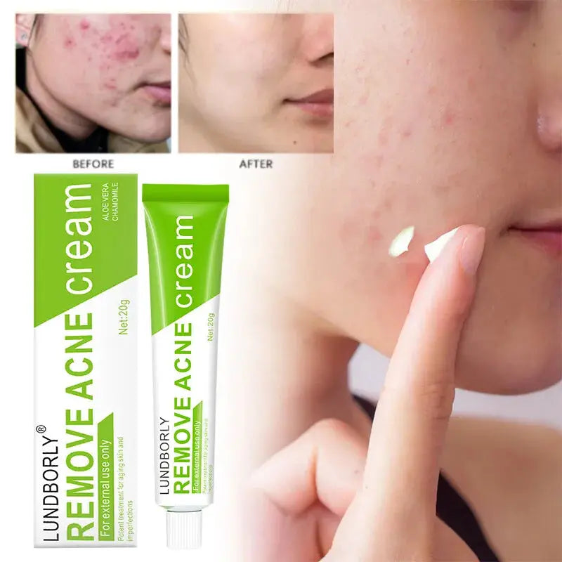Natural Herbal Face Cream 20g Acne Cream.