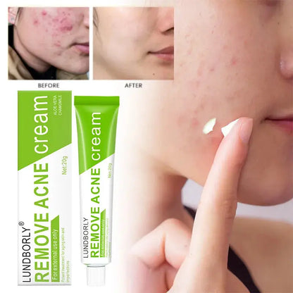 Natural Herbal Face Cream 20g Acne Cream.