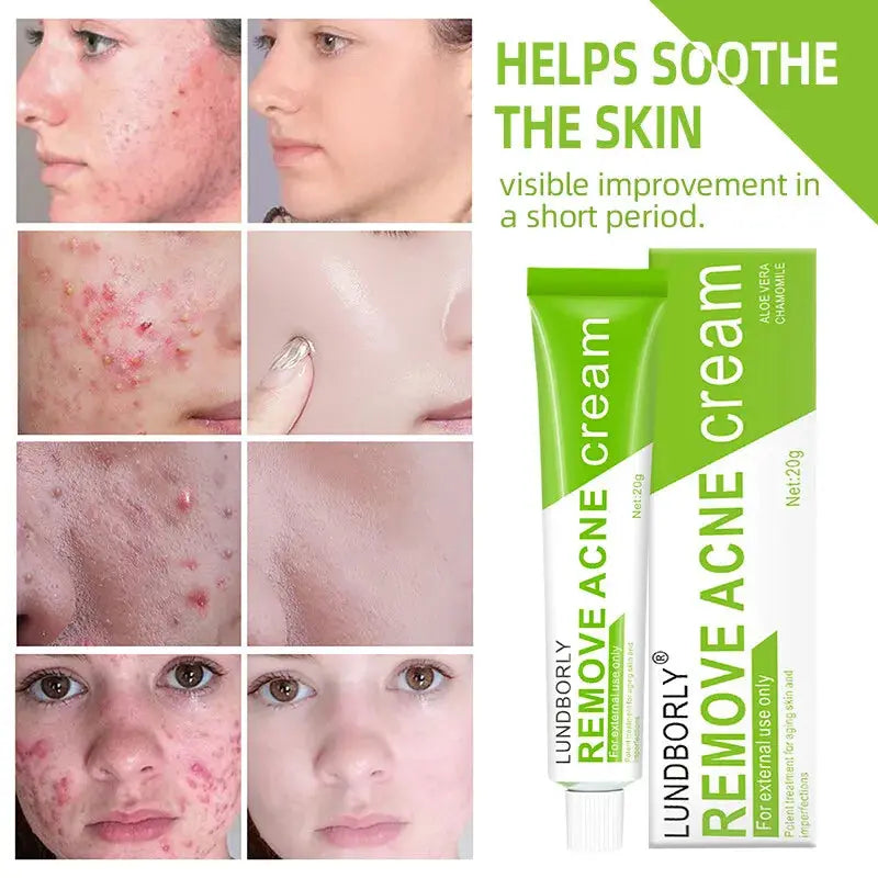 Natural Herbal Face Cream 20g Acne Cream.