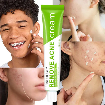 Natural Herbal Face Cream 20g Acne Cream.